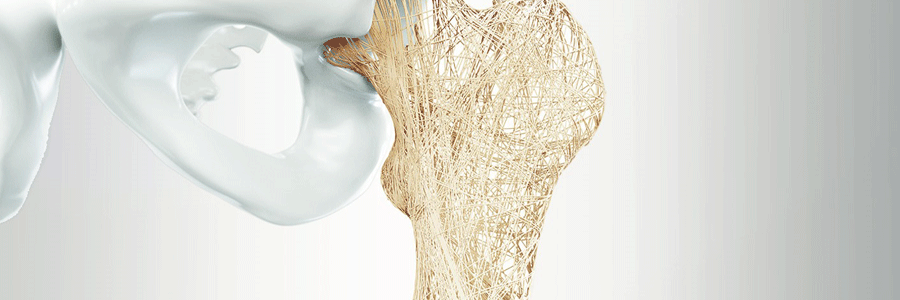 پوکی استخوان